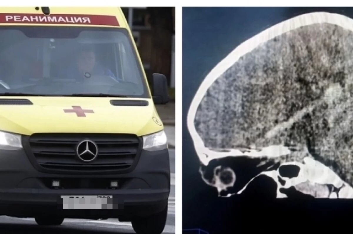    Врачам удалось спасти жизнь ребёнку с серьёзными травмами мозга и черепа.
