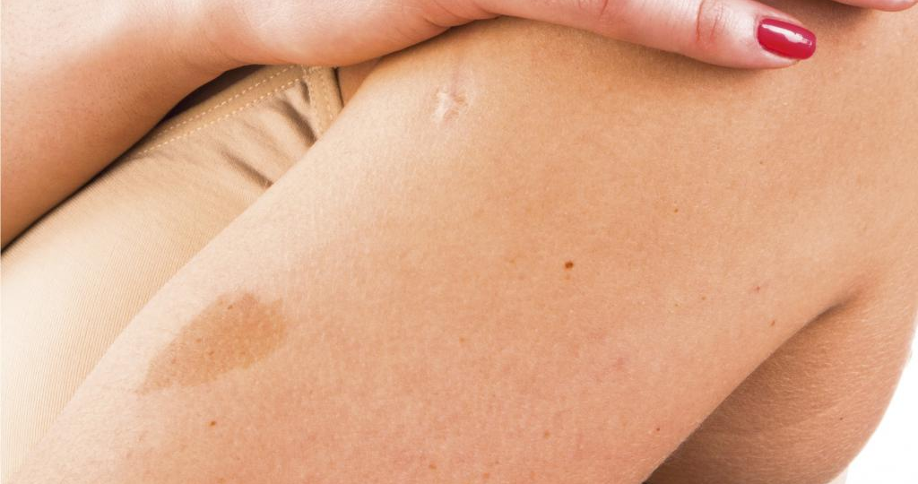 Белые, коричневые или розовые: почему возникают пятна на коже – 9 анализов, которые помогут определить причины