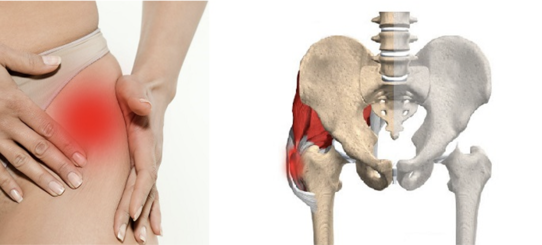 Боль сбоку в бедре: почему это происходит и что с этим делать?