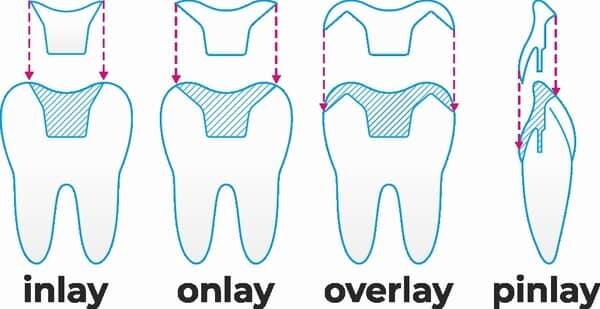 Виды коронок-вкладок