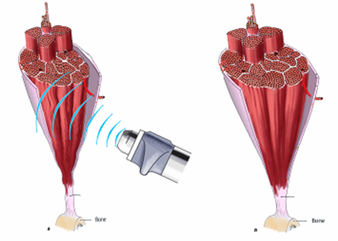 Dосстановление структуры мышечной ткани при терапии ударной волной