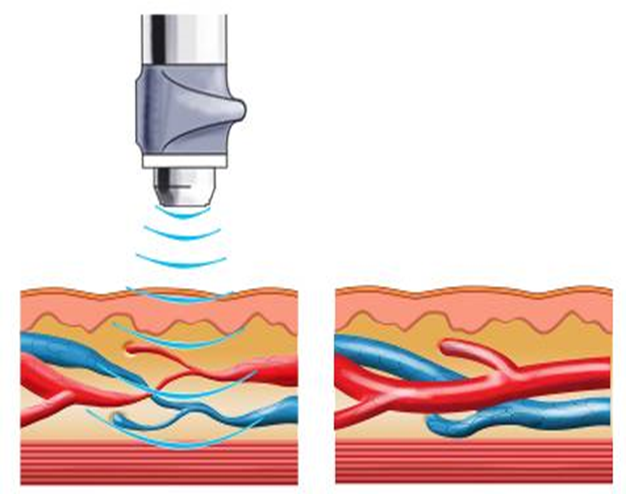 улучшение кровоснабжения - расширение сосудов при терапии ударной волной