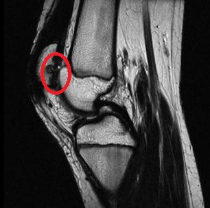 Хондромаляция -  изменение ткани хряща с утратой эластичности и размягчением