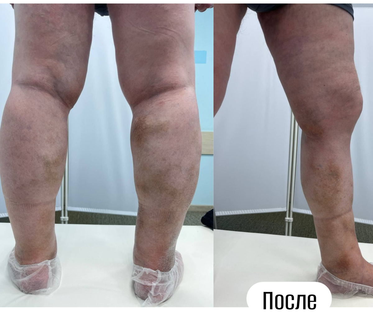 После операции