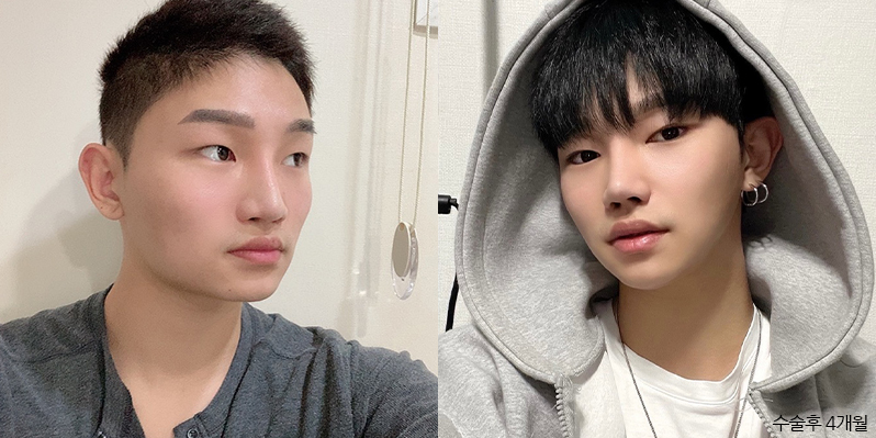 Как выглядят корейцы на самом деле? 20 шок фотографий до и после пластики