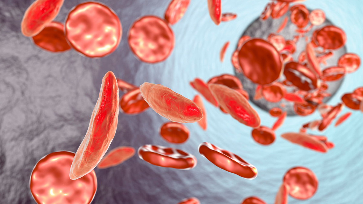    Менструальный цикл усиливает кризисы при серповидноклеточной анемии