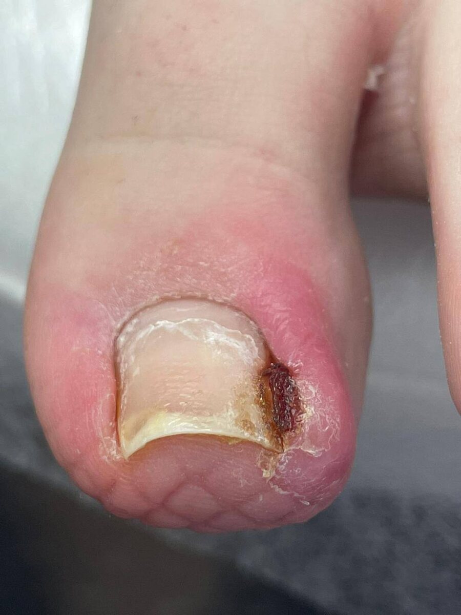 Проблема: вросший ноготь и воспаление, которое вызывает сильный дискомфорт при ходьбе.