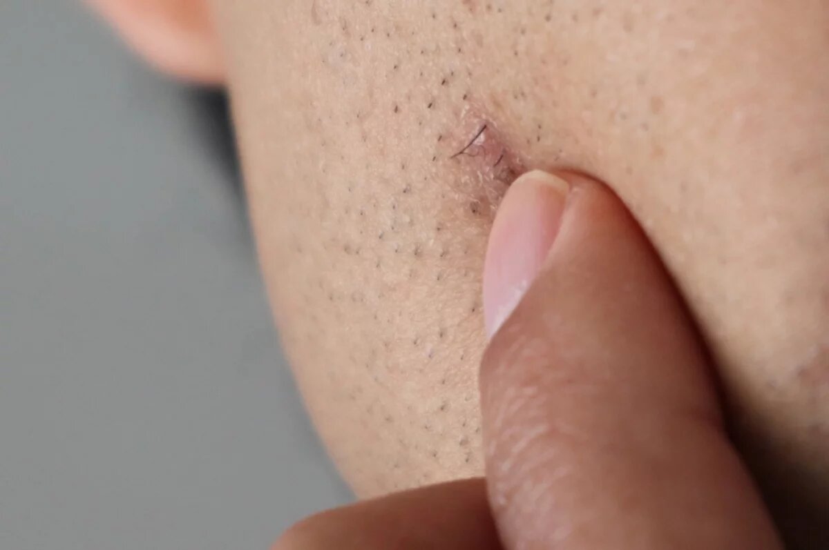    Рубцы, нарыв и операция.