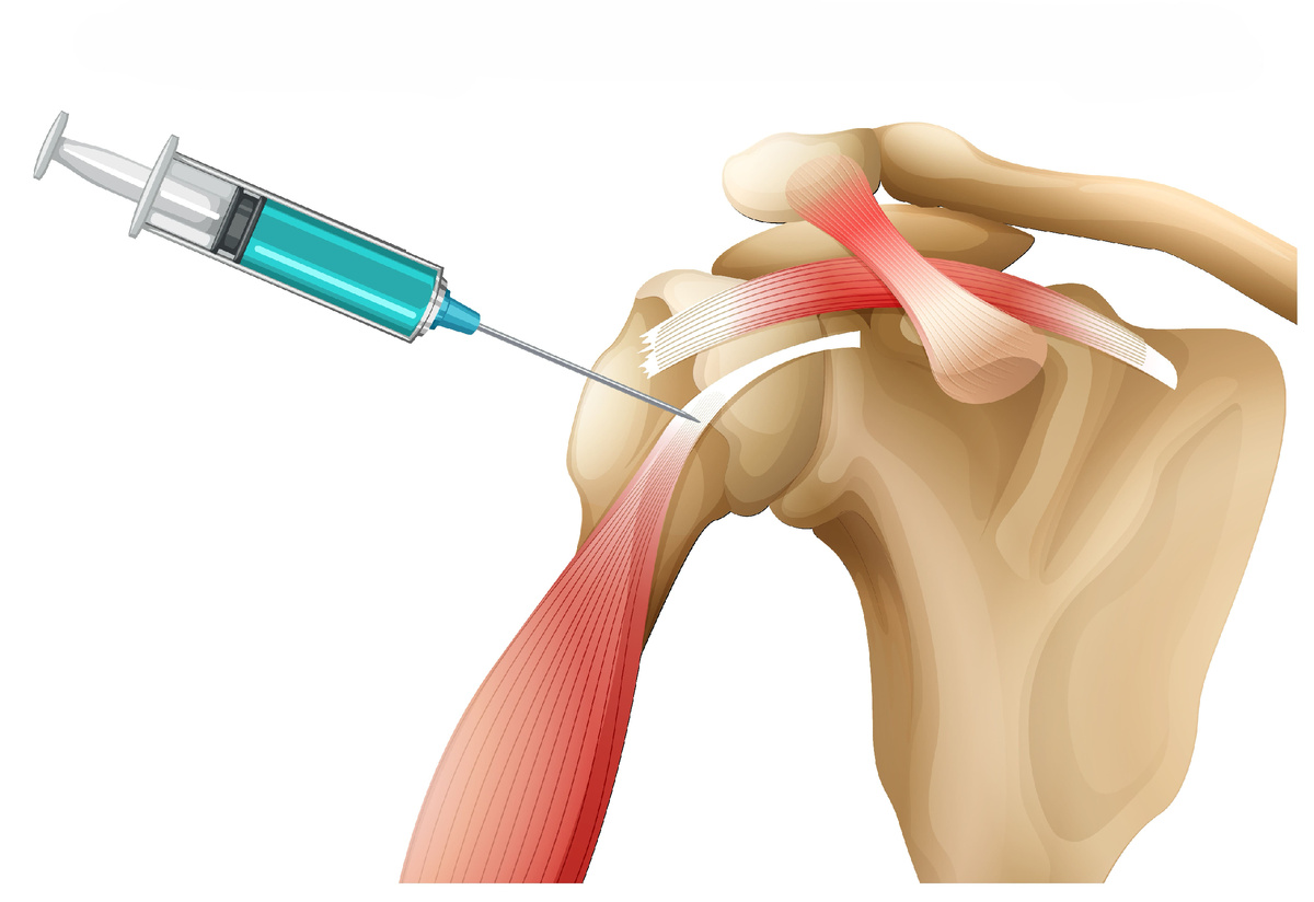 Восстановление тканей плазмой крови