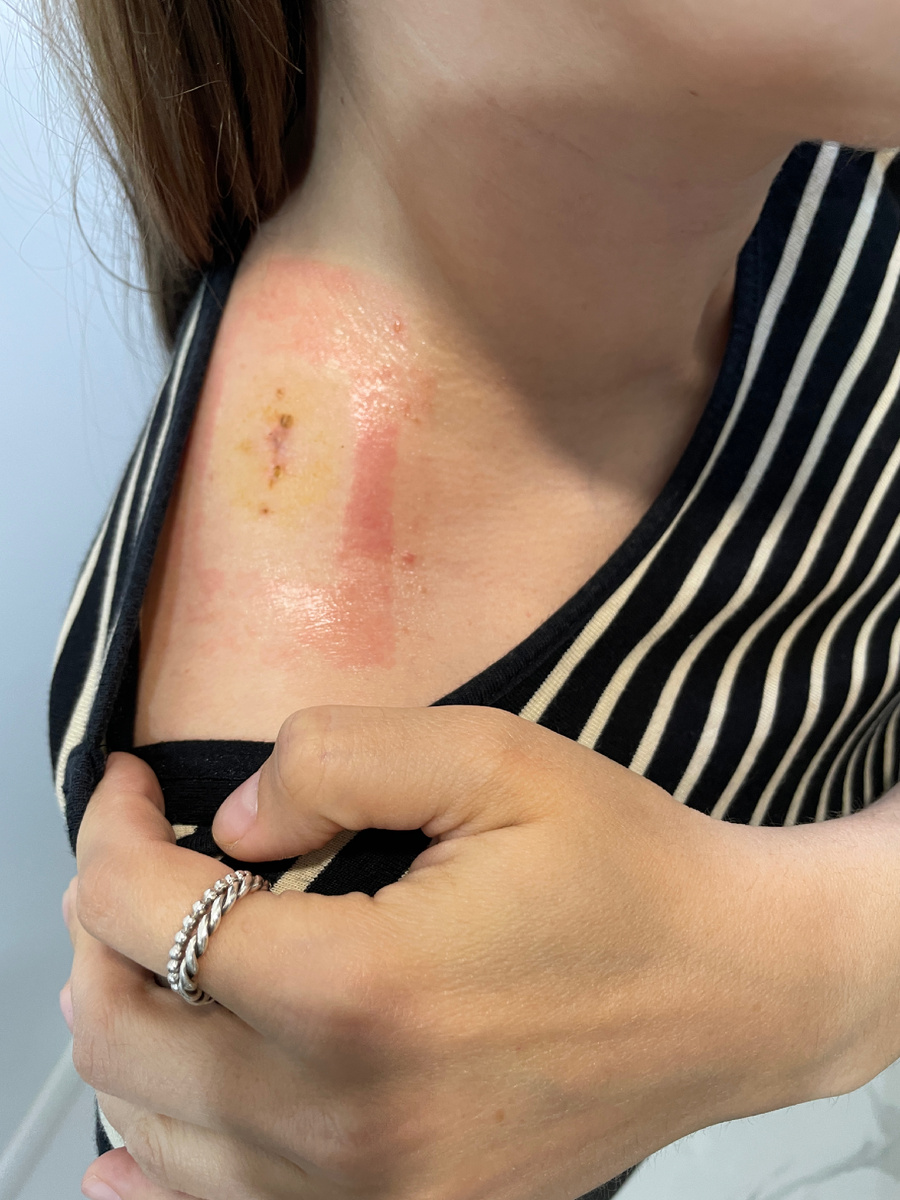 Даже успела получить ожог от пластыря 😫