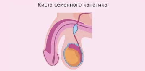 Киста семенного канатика