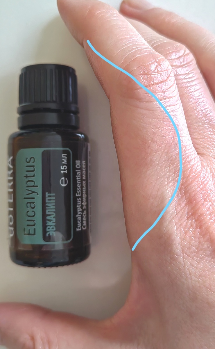 Ожог паром, спустя 5 минут. После обработки натуральным эфирным маслом Эвкалипта от doTERRA.