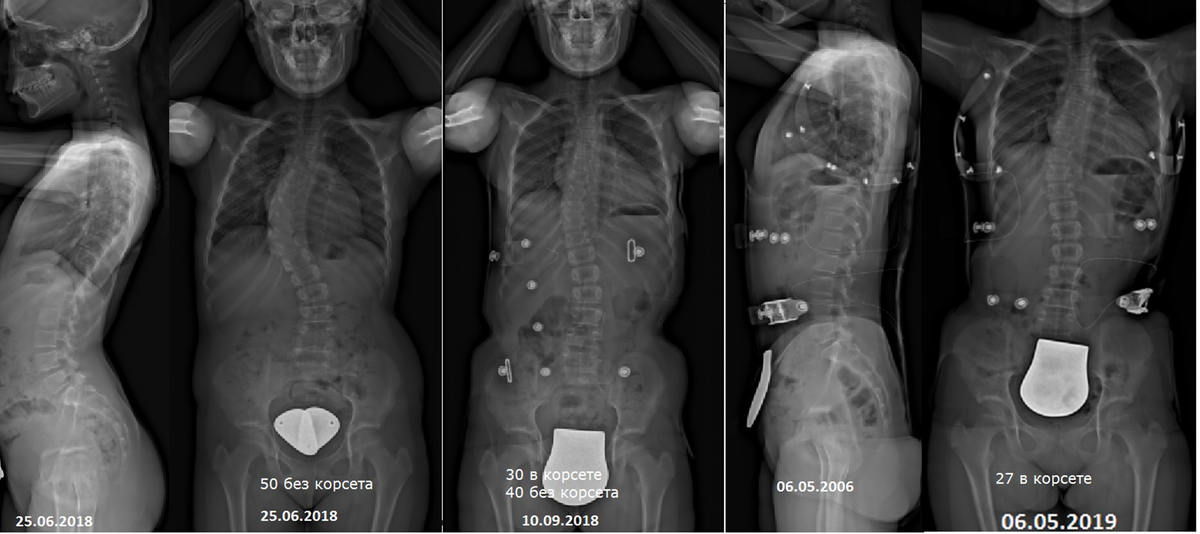 Рентгенограммы эффективного корсетолечения при сколиотической деформации позвоночника