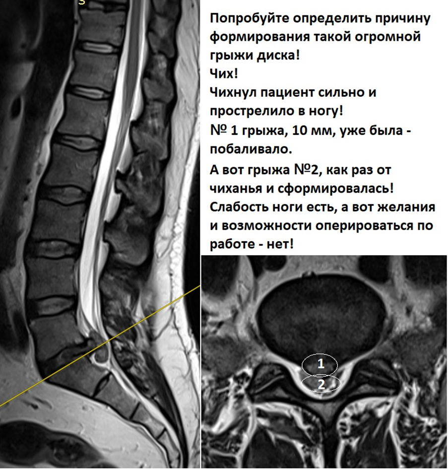 Огромная грыжа межпозвонковго диска возникшая в момент чихания.