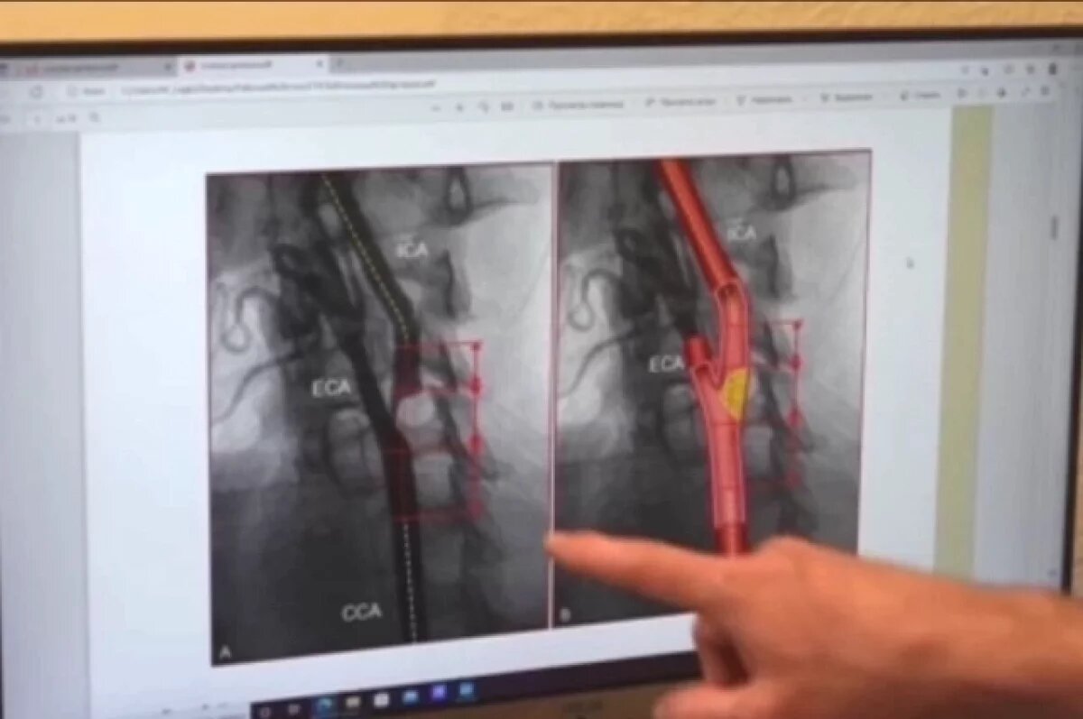    Своевременное обращение к врачам спасло волгоградца от повторного инсульта