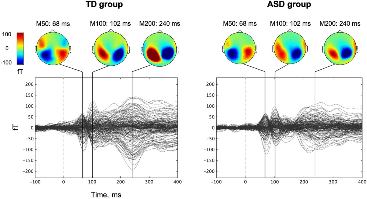    Усредненные данные с сенсоров МЭГ, записанные у типично развивающихся детей (TD group) и детей с РАС (ASD group). Цветные визуализации отражают реакцию мозга на звук, черными линиями выделены три компонента: M50, M100 и M200 / © Vardan Arutiunian, Irina Buyanova, Alina Minnigulova, Olga Dragoy, et al., Cerebral Cortex