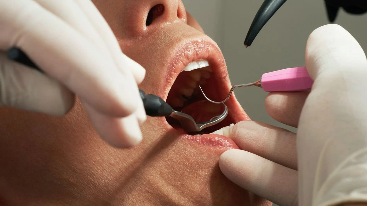 Лечение кариеса