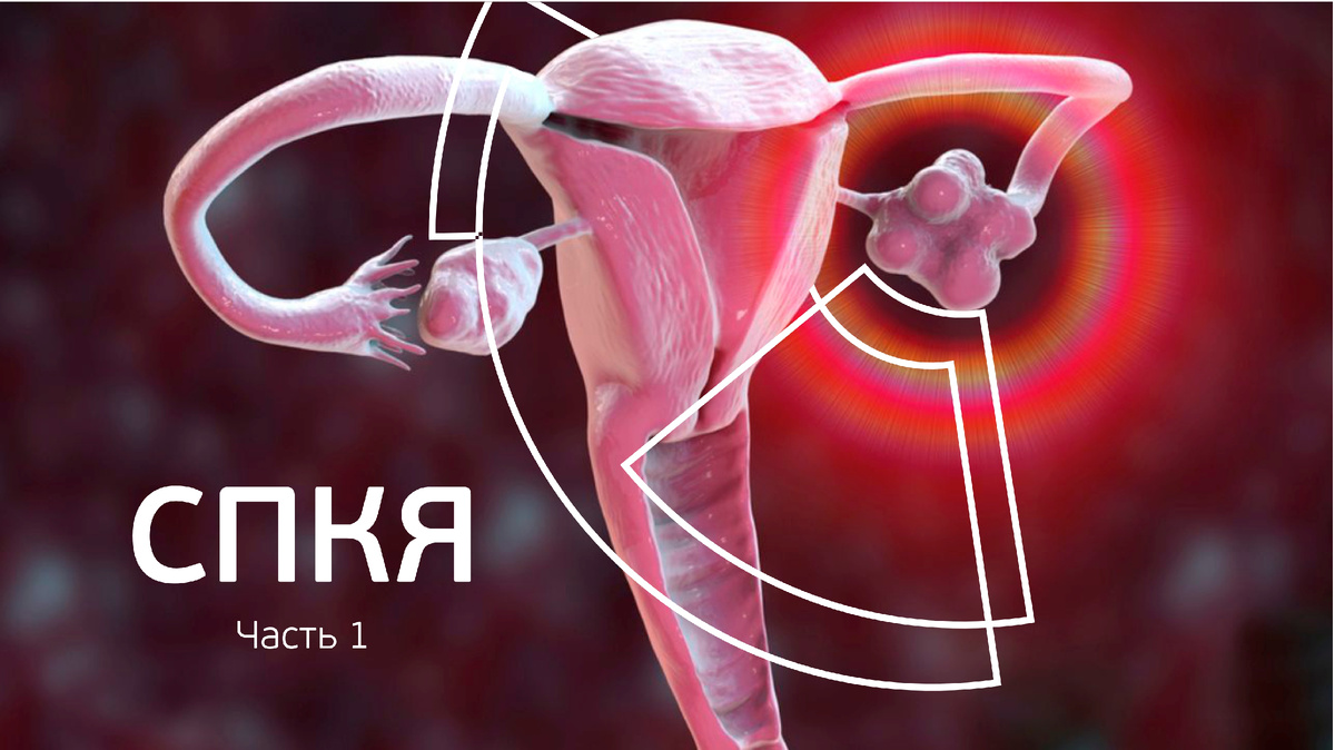 Синдром поликистозных яичников: признаки и диагностика