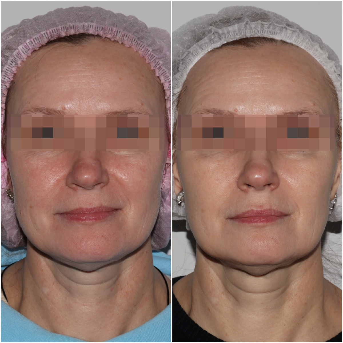 Фотоомоложение на аппарате Nordlys