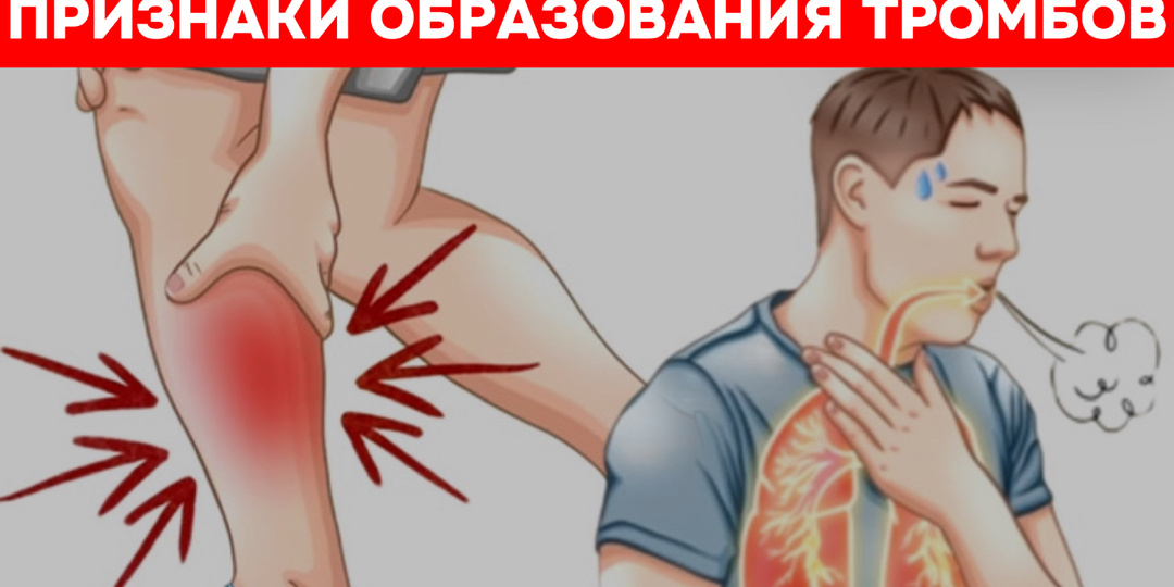 Осторожно, тромб: как распознать главный сигнал опасности в ваших венах
