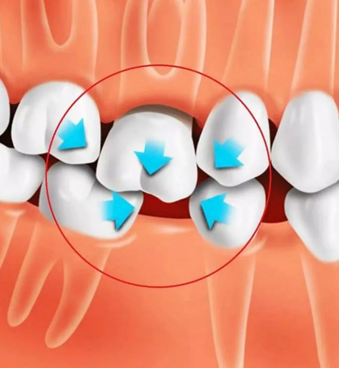 Коварные перемещения зубов схематозно