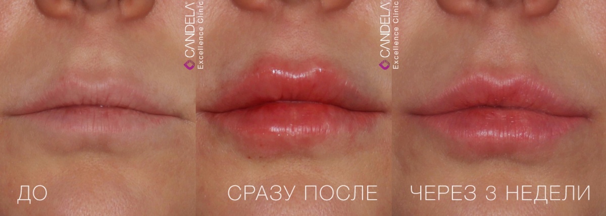 Коррекция формы губ