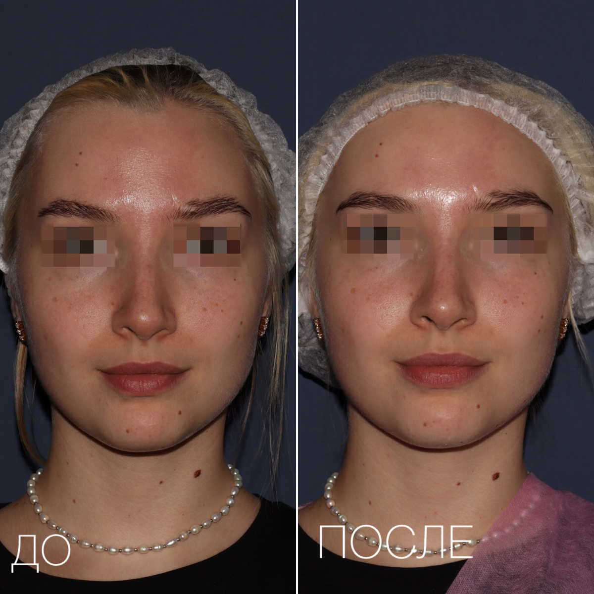 Hydrapeel - вакуумный гидропилинг лица