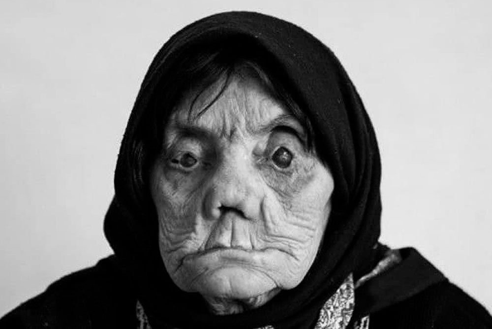    Женщина болеющая лепрой (проказой) Фото: @ Фото: Соцсети