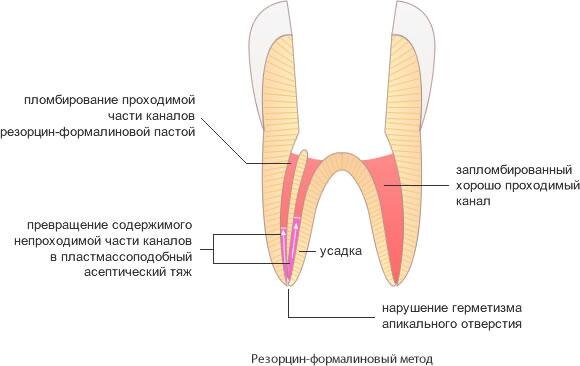Лечение зубов с использованием резорцин-формалиновой пасты