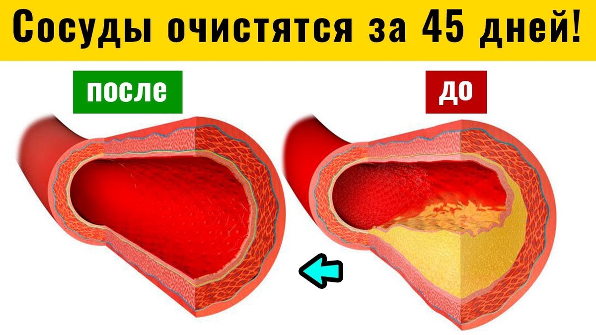 Чистые сосуды – здоровая жизнь: самые эффективные способы избавиться от вредного холестерина