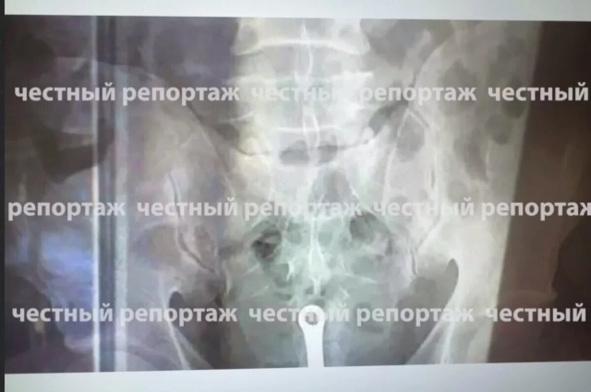    Житель Уфы с ершиком в заднем проходе обратился за помощью медиков