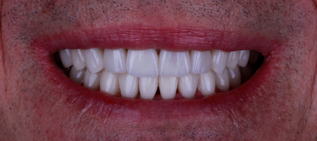 Виниры. Вопросы и ответы.