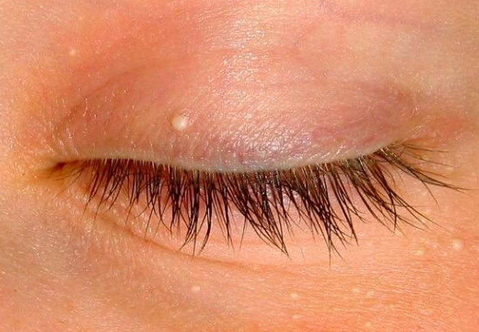 Что кожа может рассказать о вашем холестерине: 10 признаков, которые нельзя игнорировать