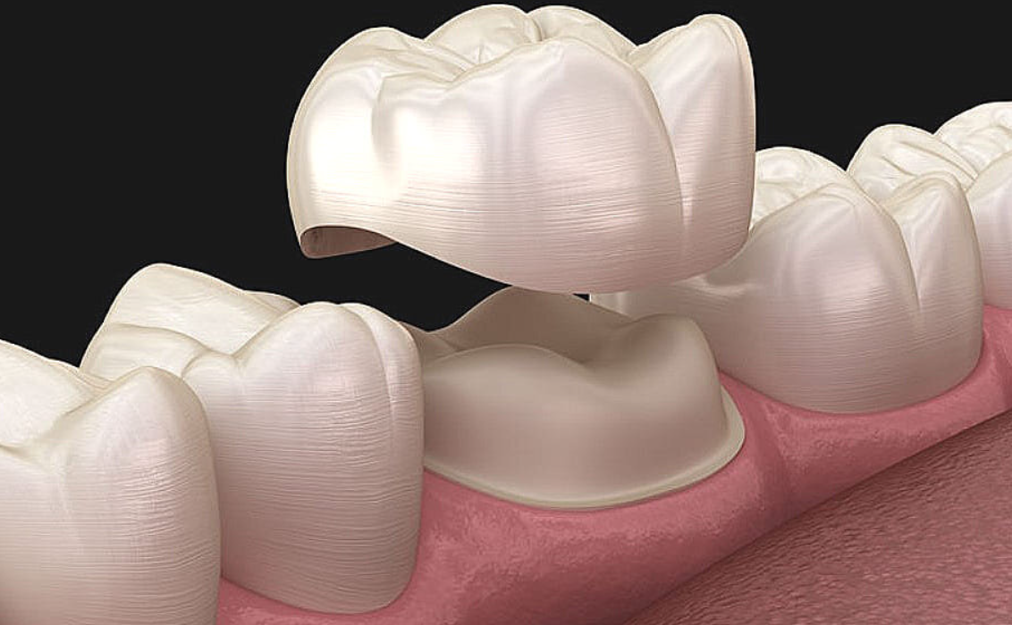 Коронка на зуб