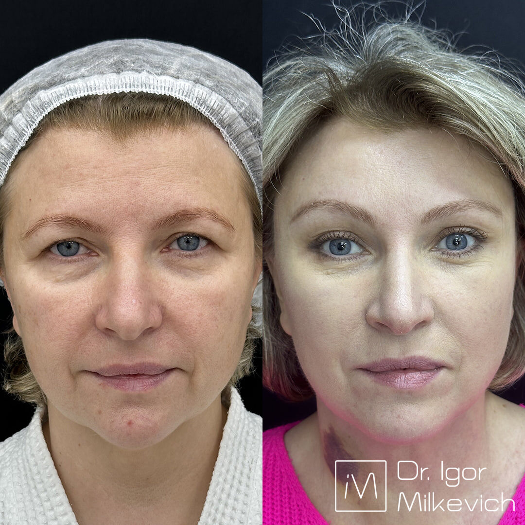 Здесь выполнена только эндоскопическая подтяжка лба