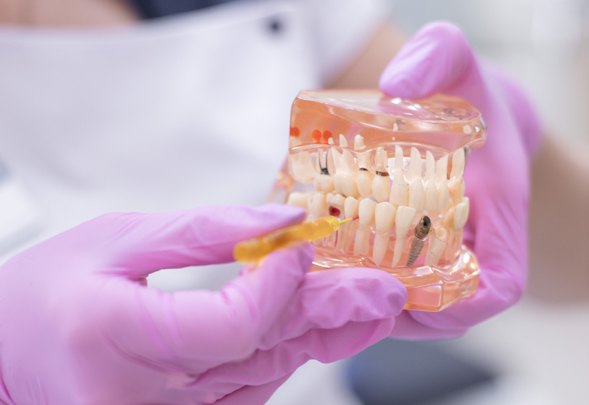 Имплантация — всегда отличный шанс восстановить жевательную функцию зуба!
