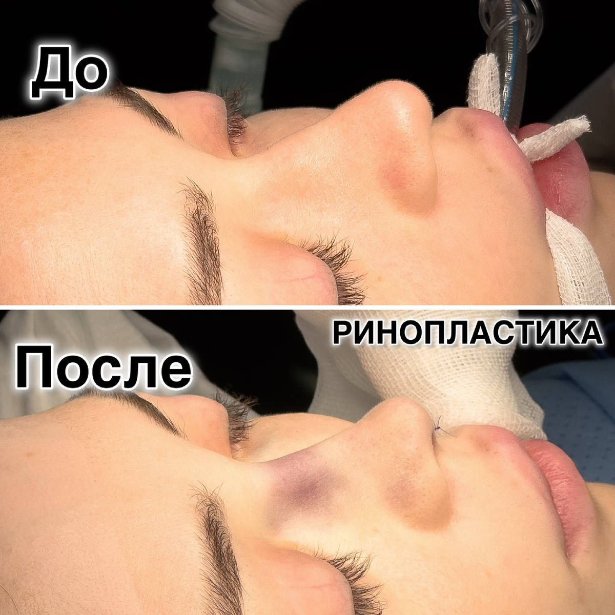 Закрытая ринопластика, пластический хирург Стайсупов В.Ю.