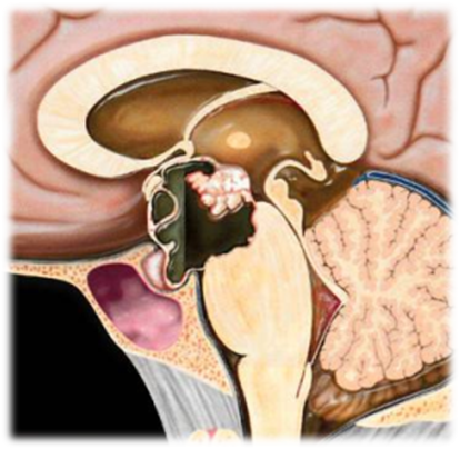 Рис. 1. Адамантиноматозная краниофарингиома (графическое изображение). Образование типичной локализации, основная часть образования представлена кистозным компонентом (солидная часть присутствует, но составляет относительно небольшую долю), содержимое кистозной части с эффектом седиментации за счет компонентов разной плотности, солидная часть с участками кальцинации [1].