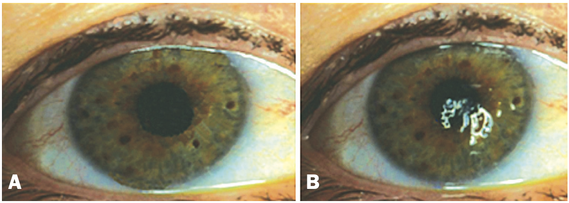     Базальные слезы образуют гладкую пелену на роговице (А), если эту пленку нарушить (В), зрение наземных позвоночных становится хуже J. Murube / Sources in time, 2009