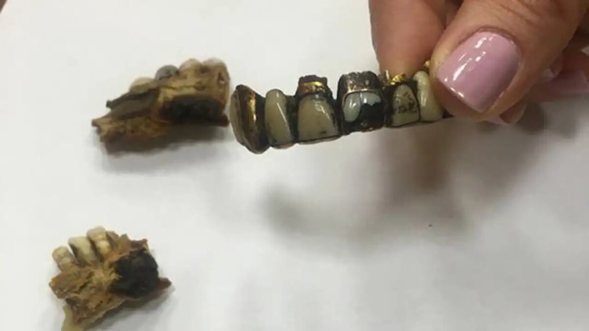    Фото челюсти Адольфа Гитлера.