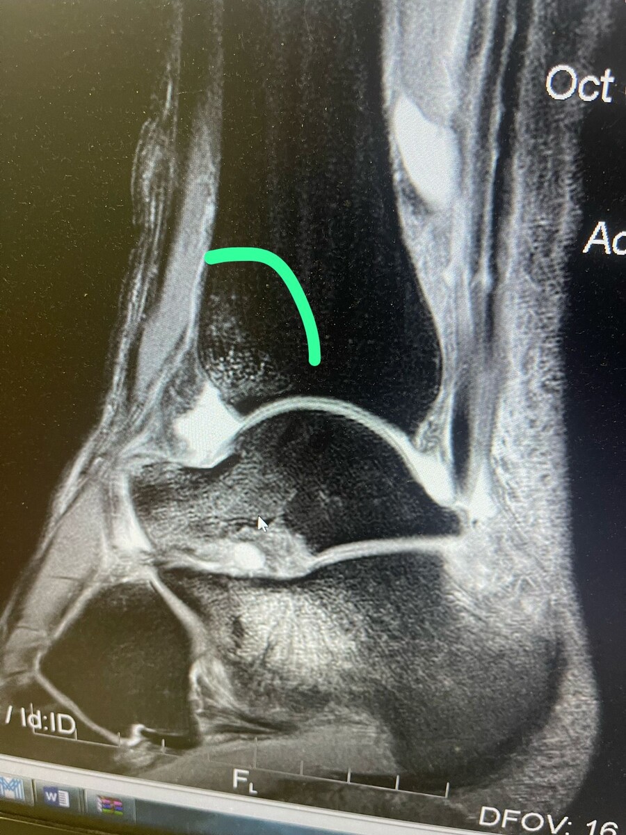 Снимок поврежденного голеностопного сустава