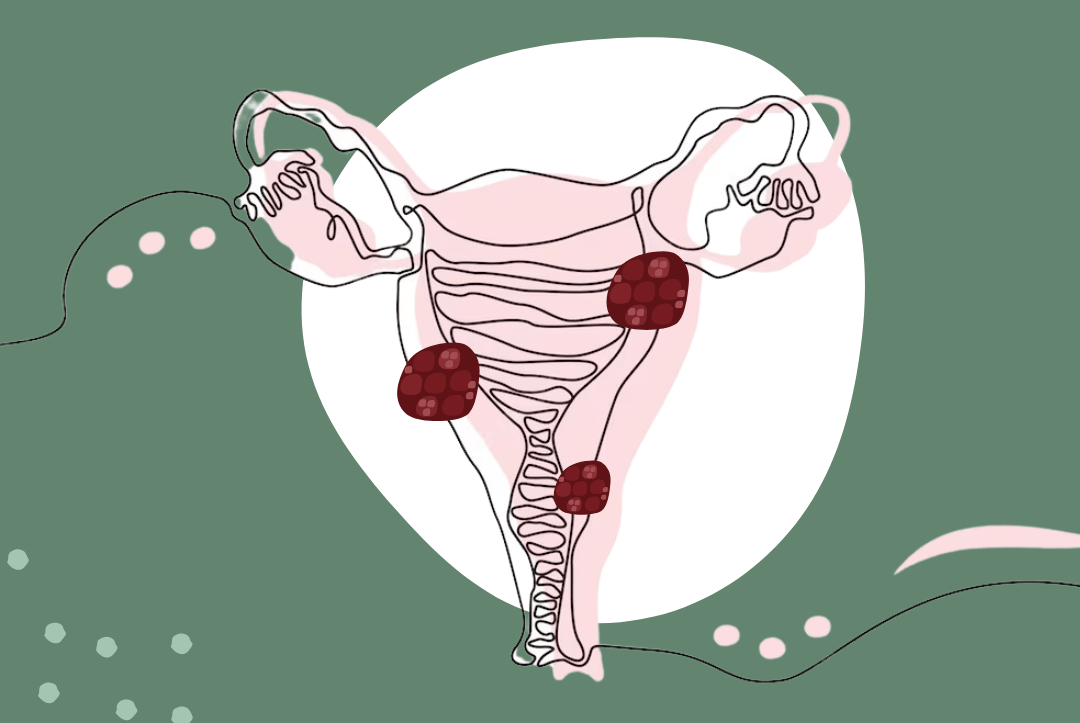 Подслизистая миома матки