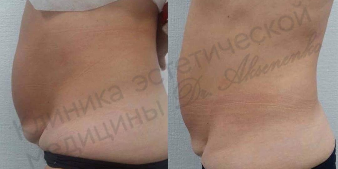 Метод моделирования фигуры и устранения жировых отложений