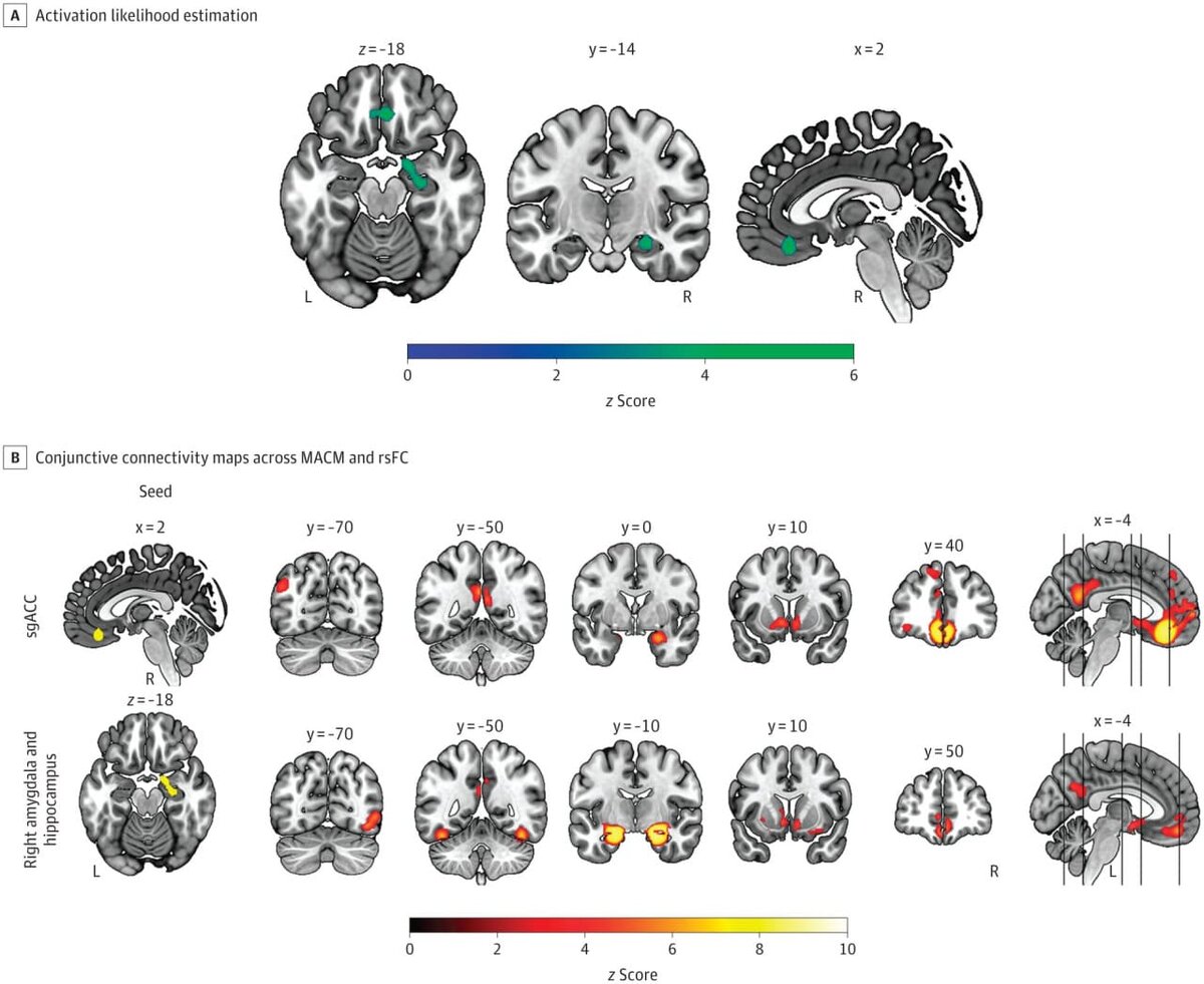    Изменения в отделах мозга при хронических нарушениях сна / © Reimann GM, Hoseini A, Koçak M, et al., JAMA Psychiatry