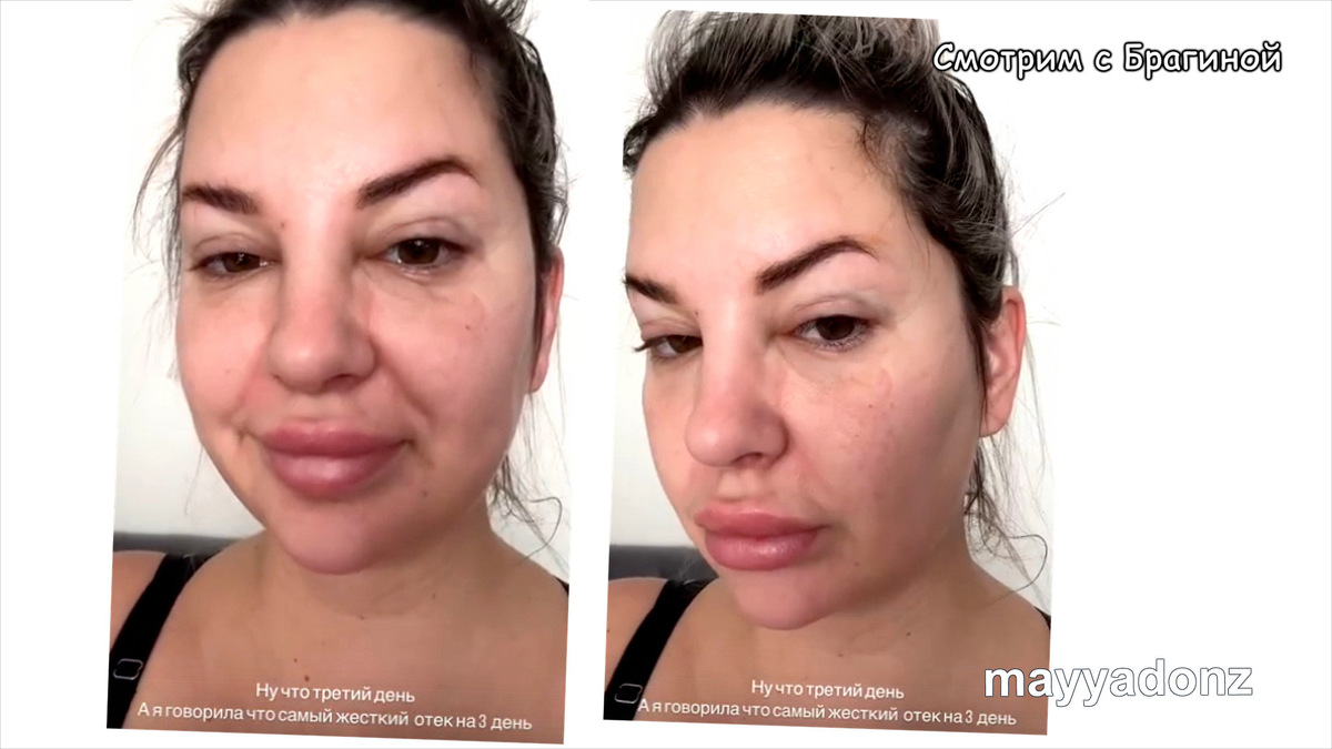 Фото: соцсети. Майя Донцова показала отёки после операции