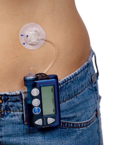 инсулиновая помпа от фирмы Medtronic