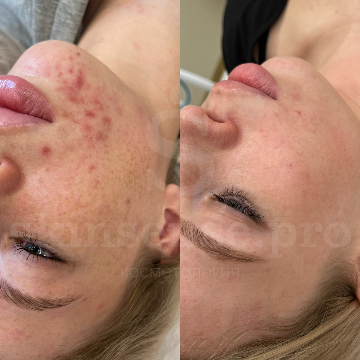 Пациентка клиники косметологии Skinsense после курса процедур