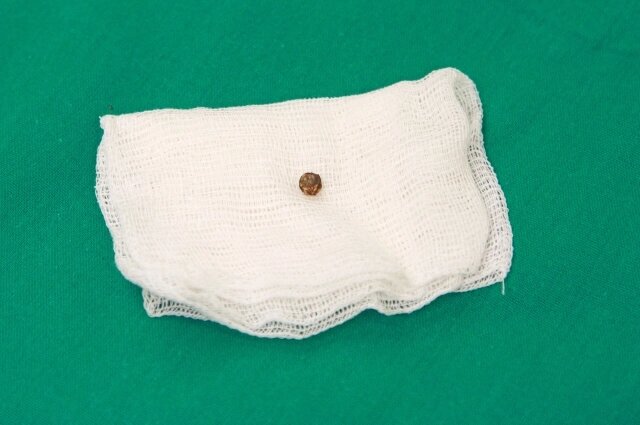    В сердце бойца застрял маленький осколок. Фото: пресс-служба РКБ