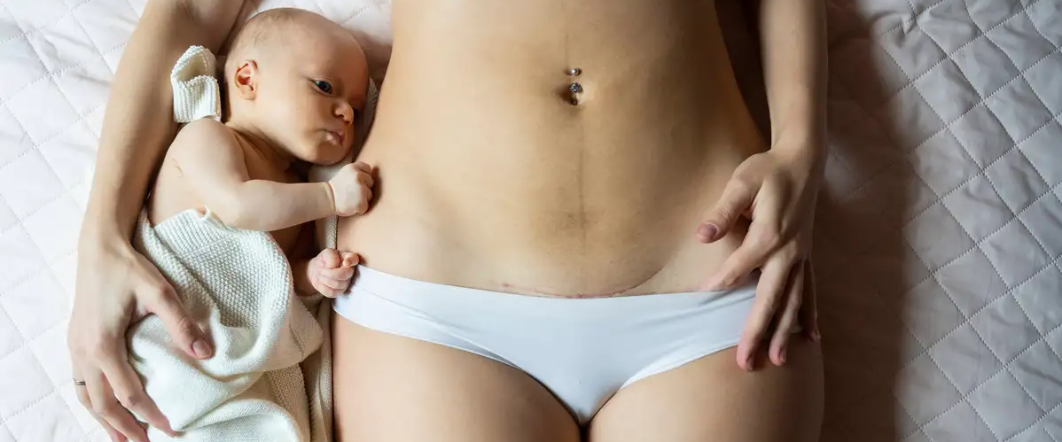 Младенец рядом с матерью, у которой на животе следы от кесарева сечения