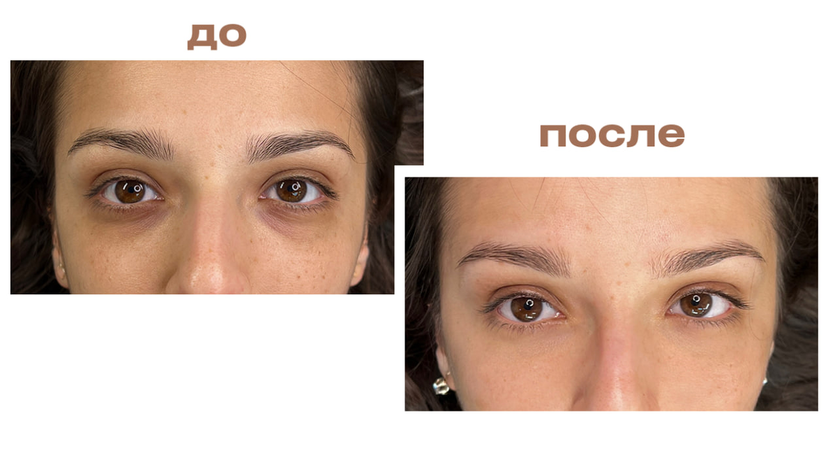 Камуфляж тёмных кругов под глазами — главный тренд перманентного макияжа 2025 года

Эта техника стремительно набирает популярность — и вот почему.

💡 Что это такое?
Камуфляж позволяет замаскировать тёмные круги и синяки под глазами, которые могут появляться из-за усталости, возрастных изменений или наследственности.

 ✍️ Как проходит процедура

Процедура может проходить без анестезии — многие мастера отказываются от неё, потому что на обезболенной коже пигмент ложится хуже.
‼️ Но нужно быть готовым: это очень больно.
Зона под глазами — одна из самых чувствительных на лице. По уровню дискомфорта с ней можно сравнить разве что губы.

Сам процесс напоминает череду лёгких чиркающих движений — мастер ставит «точки» или «запятые», а не проводит сплошные линии. Однако техника может различаться от специалиста к специалисту.

Лично у меня есть сомнения и опасения по поводу этой процедуры — всё-таки кожа под глазами тонкая, и любое вмешательство должно быть максимально деликатным.
Но если проблема настолько вас беспокоит, что ни боли, ни возможных последствий вы уже не боитесь, — камуфляж может стать инструментом, который действительно решает проблему.

❗️На что обратить внимание?

* Ищите мастера с подтверждённым опытом и сильным портфолио.
* Пигмент должен идеально совпадать с тоном кожи — иначе результат будет заметен.
* Учитывайте, что результат — не навсегда, но держится довольно долго.

🚫 Противопоказания:
* дерматиты, воспаления кожи,
* склонность к келоидным рубцам,
* онкологические заболевания,
* выраженные жировые грыжи в нижнем веке,
* повышенная сосудистость кожи,
* беременность и лактация.

🚫 Также нельзя проводить процедуру сразу после:

* инъекций ботулотоксина (в область лба и бровей),
* срединных и глубоких пилингов.
  Минимальный перерыв — 28 дней.

Решились бы или лучше по старинке консилером? 

#статья #книгазнаний #перманент